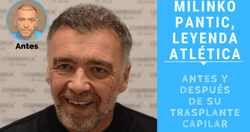 Milinko Pantic habla de su experiencia tras su trasplante capilar con Microfue